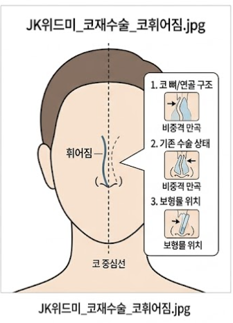 【松島整形外科】隆鼻重修手術:明明做過一次,為什麼還需要重做? 사진 4